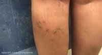زالو درمانی برای رفع رگهای عنکبوتی مناسب نیست