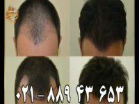 کاشت مو به روش SUT مرکز مو رنسانس