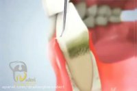 فیلم باور نکردنی از جرم گیری دندان و درمان التهاب لثه