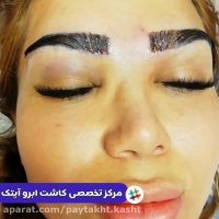 کاشت ابرو انجام شده | کلینیک آیتک | 44228594-021