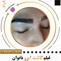 کاشت ابرو طبیعی | کلینیک پایتخت | 44228594-021