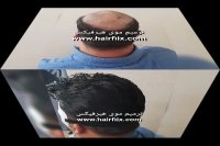 ترمیم مو/هیرفیکس09337859955