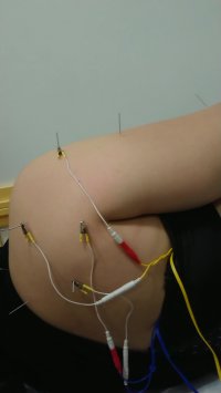 درمان شانه درد با تکنیک الکترو اکوپانچر