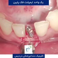 یک واحد ایمپلنت فک پایین