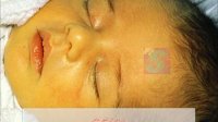 علت ابتلای نوزادان به زردی چیست؟