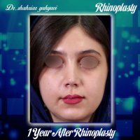 یک سال بعد از جراحی بینی