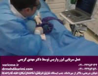 عمل سرپایی واریس