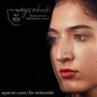 رینوپلاستی و تغییرات بینی بعد از آن