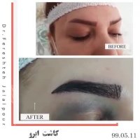 فیلم کاشت ابرو دکتر فرشته جلال پور