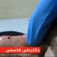 فیلم ❌تزريق فيلر به بينى❌ بدون نياز به جراحى و بيهوشى