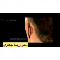 اتوپلاستی ترمیمی و جراحی گوش بیرون زده-دکتر رزیتا جعفری