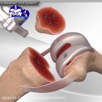 عملیه استبدال مفصل الرکبه الیمنی