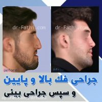فیلم جراحی فک بالا و پایین به همراه جراحی بینی