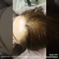 اسکالپ تخصصی روشی نوین برای رفع کم پشتی موهای سر