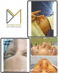 فیلم سه هفته پس از جراحی زیبایی بینی