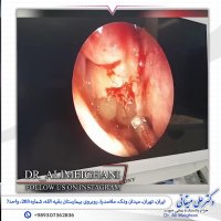 برداشتن پولیپ بینی