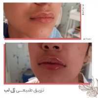 فیلم تزریق ژل لب