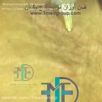 فیلم آموزشی از بین بردن ترک های پوستی  با کربوکسی تراپی