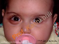 فیلم جراحی تومور اربیت یا حدقه | پروفسور کشکولی | جراح پلک تهران