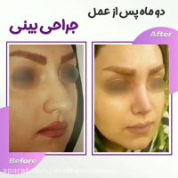 جراحی بینی بعد از دو ماه
