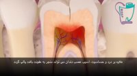 دندان شکسته و درمان آن | سیمادنت