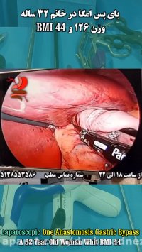 اولین عمل سال 1399 - بای پس امگا در خانم 32 ساله