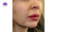 تزریق ژل لب و ژل چانه در کلینیک ارکیده