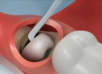 روش جدید جراحی دندان عقل