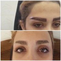 کاشت ابرو طبیعی کلینیک رنسانس
