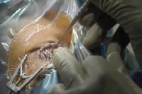 ترمیم اپیتلیوم قرنیه چشم بعداز عمل