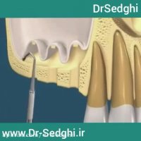عدم داشتن فضا برای به کار گیری ایمپلنت