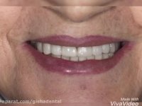 دکتر عزیز گشاده رو متخصص پروتز های دندانی و ایمپلنت