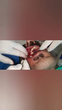 جراحی دندان کانین (نیش) نهفته توسط دکتر شهریار جنانی