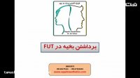 برداشتن (کشیدن) بخیه در روش FUT