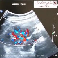 سونوگرافی کالرداپلر عروق کلیه