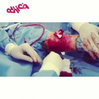 درمان پیودرما گانگرنوزوم