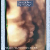 سونوگرافی چهاربعدی جنین پسر
