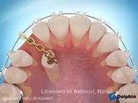 ارتودنسی دندان نیش نهفته