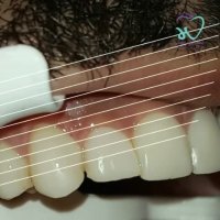 فیلم کامپوزیت ونیر دو فک