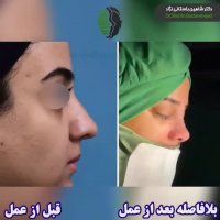 ویدئوی جراحی بینی گوشتی
