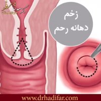 زخم دهانه رحم چیست ؟