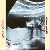 فیلم سونوگرافی ۱۸ هفته ای  از ناحیه صورت