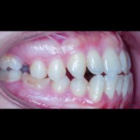 ارتودنسی بدون جراحی فک | دکتر داودیان