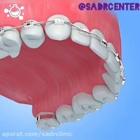 برهم ریختگی دندان ها