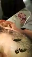 تایم لپس زالو درمانی در چند ثانیه   بهزاد زمانی