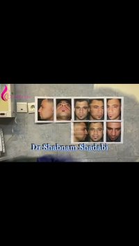 فیلم عمل جراحی بینی پهن و گوشتی