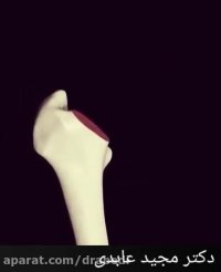 جراحی تعویض مفصل لگن