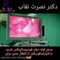 لاپاراسکوپی قبل از انتقال جنین برای IVF