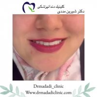 هزینه لمینت سرامیکی