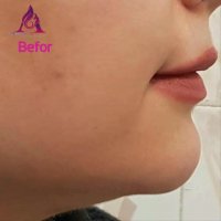 نمونه تزریق فیلر هیالورونیک اسید به چانه